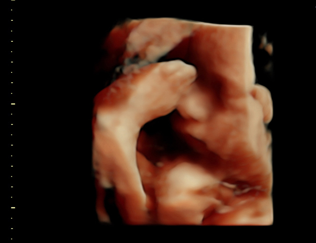 3D ultrasound image at 31 weeks